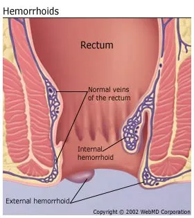 Hemorrhoids anatomical diagram