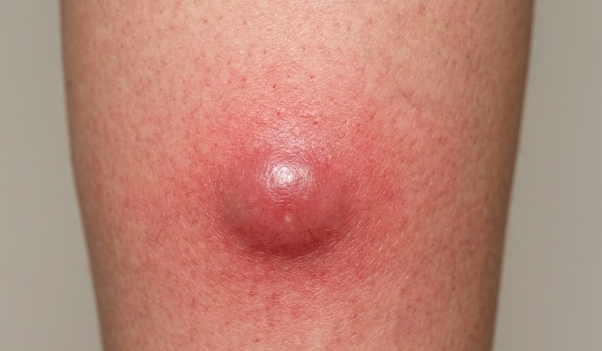 Close-up of a swollen, red abscess on the skin showing signs of infection and inflammation