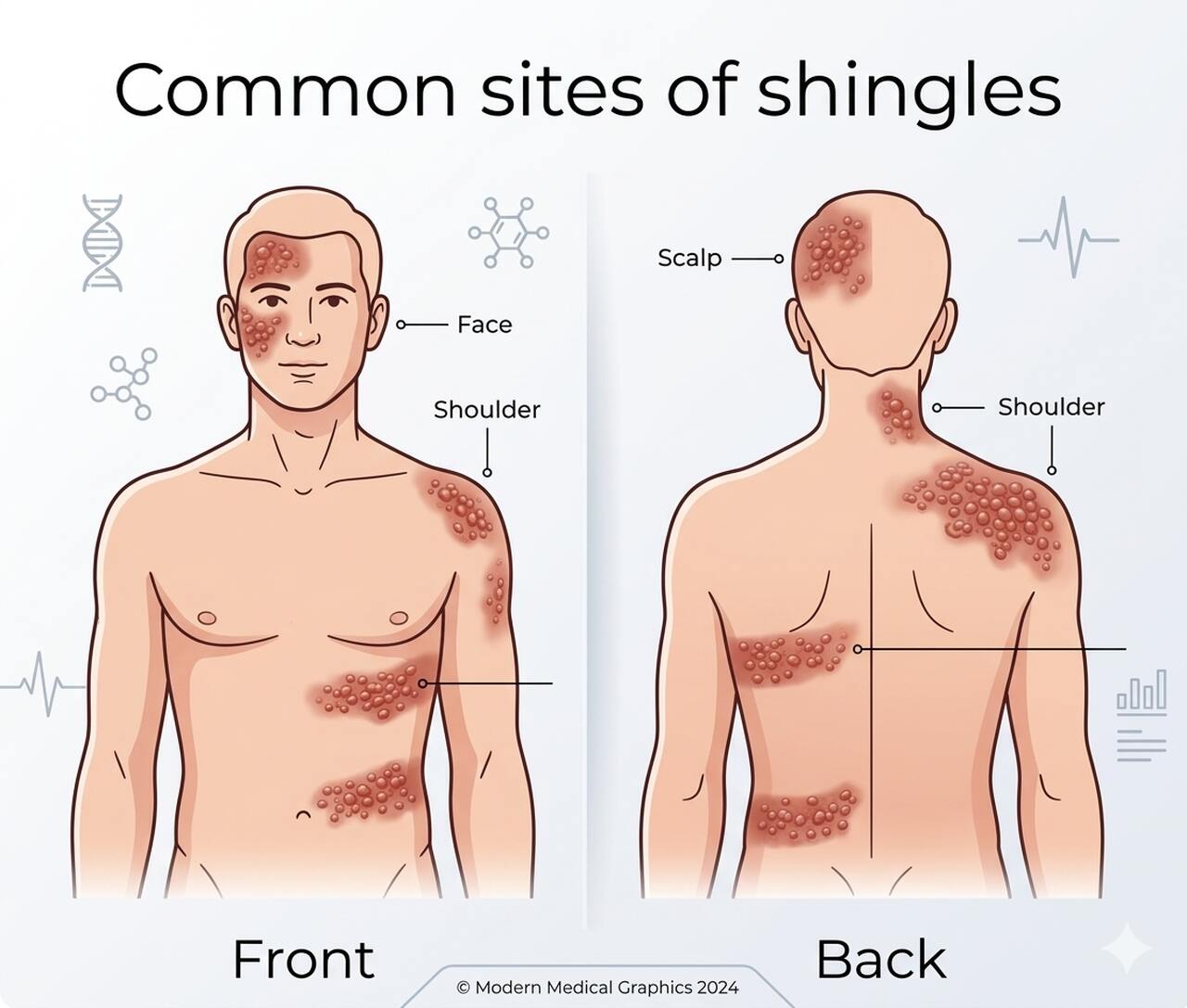 chart showing the common sites of shingles