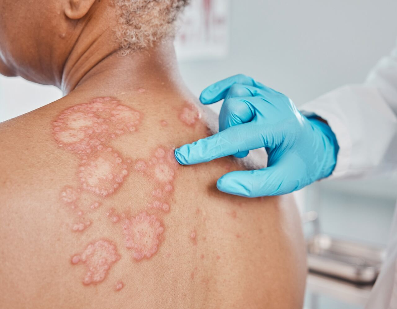 Hepatitis B Rashes Hepatitis Vaccine (A & B) | Mill Basin Physician (11234) | Internal ...